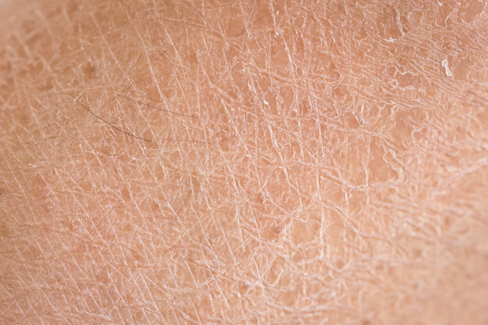 dry skin (ichthyosis) detail