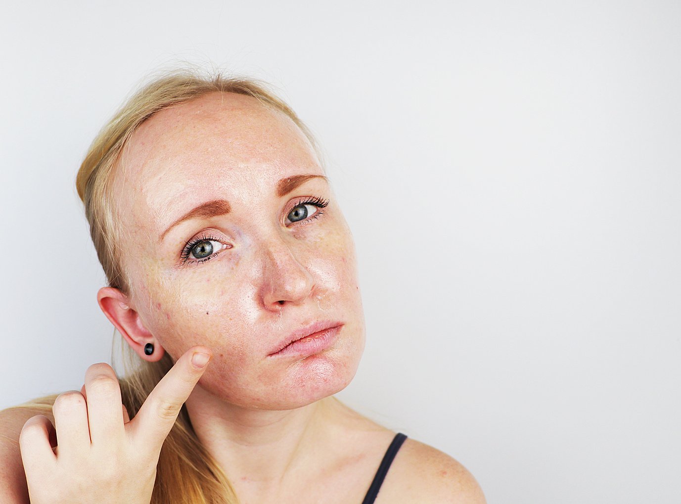  Girl with Acne, Oily Skin and Pigmentation