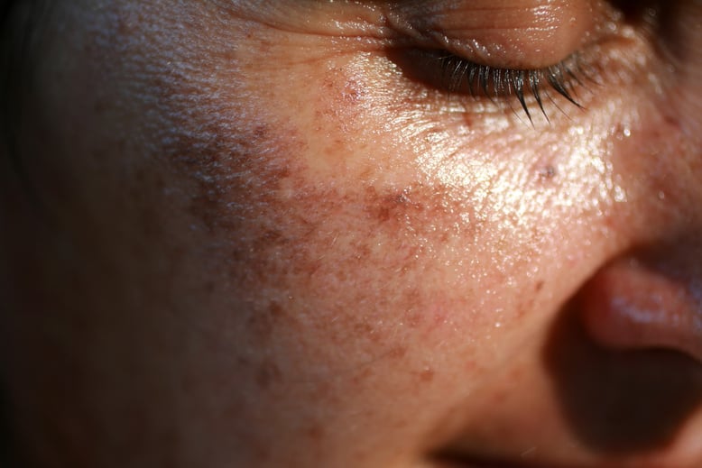 Pigmented spots on the face. Pigmentation on cheeks