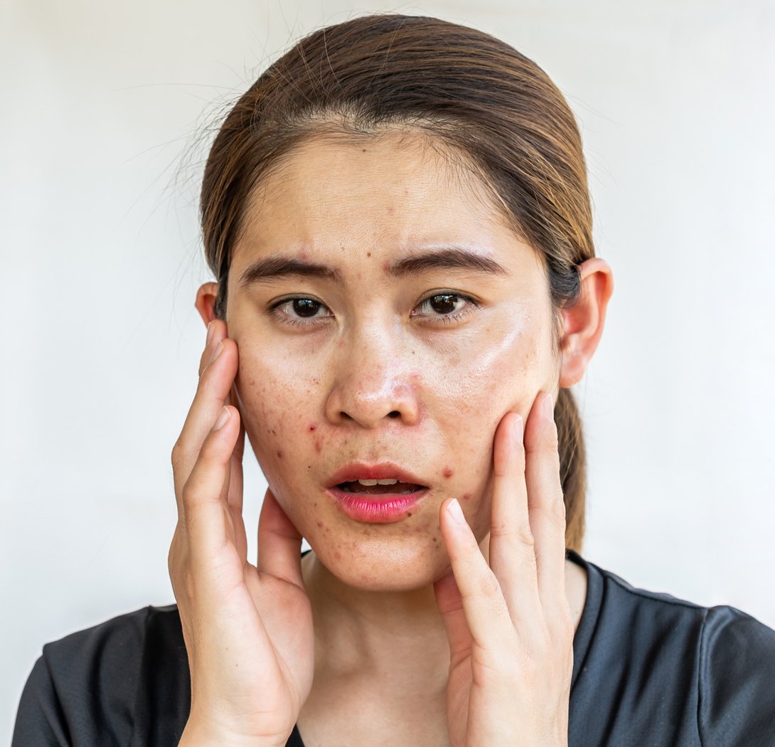 Portrait of Asian woman having problems of oily skin with acne inflamed on her face.