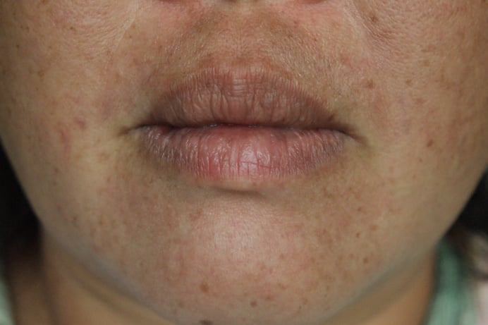 Facial Skin Problem of a Woman Closeup