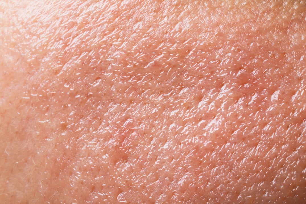 Closeup View of Human Oily Skin as Background